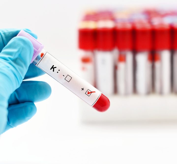 Niedobór potasu (hipokaliemia)